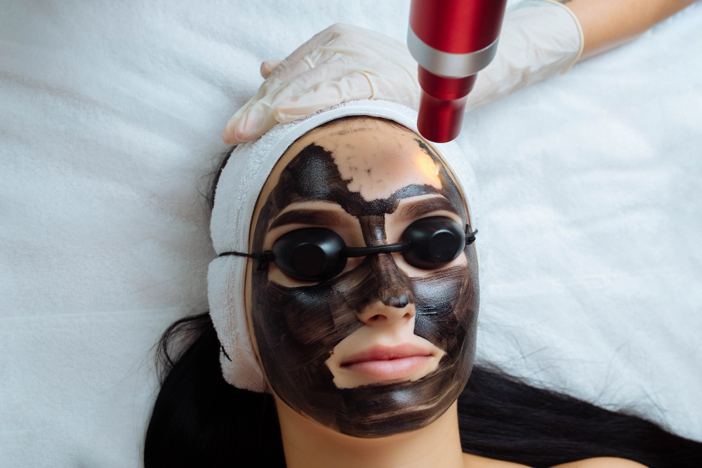 Carbon Laser Facial